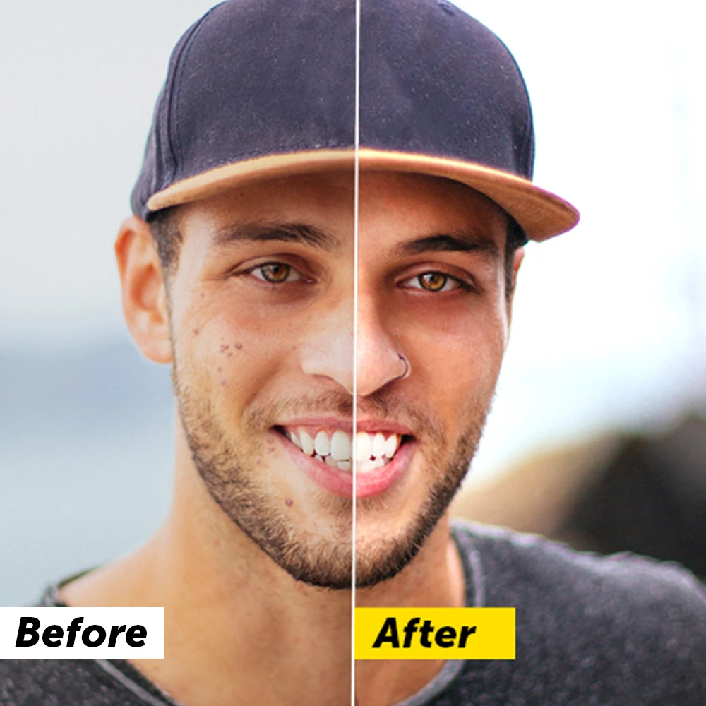 Teeth whitening before and after photo